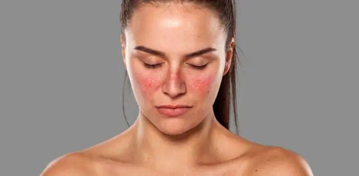 an image of a woman displaying the symptoms of Lupus